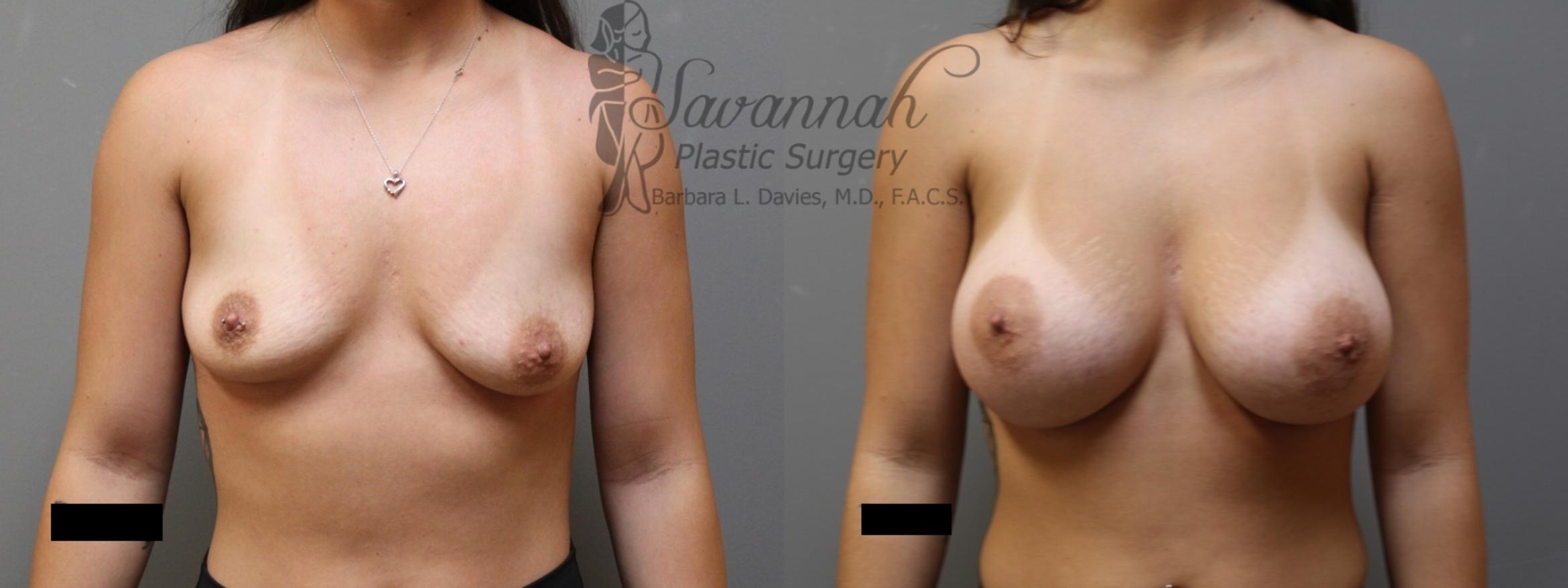 Before & After Breast Augmentation Case 6 View 1 View in Savannah, Georgia
