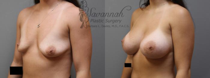 Before & After Breast Augmentation Case 6 View 2 View in Savannah, Georgia
