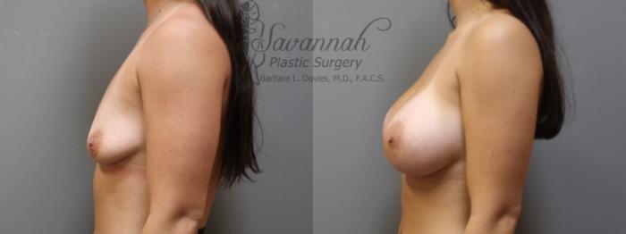 Before & After Breast Augmentation Case 6 View 3 View in Savannah, Georgia