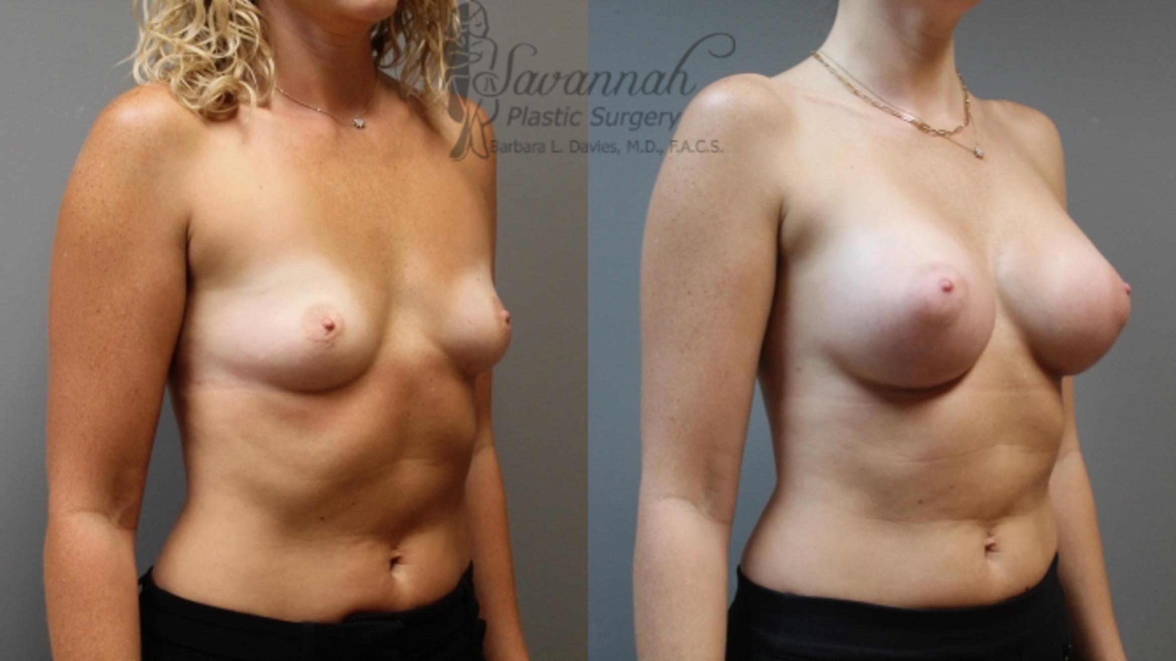 Before & After Breast Augmentation Case 7 View 2 View in Savannah, Georgia
