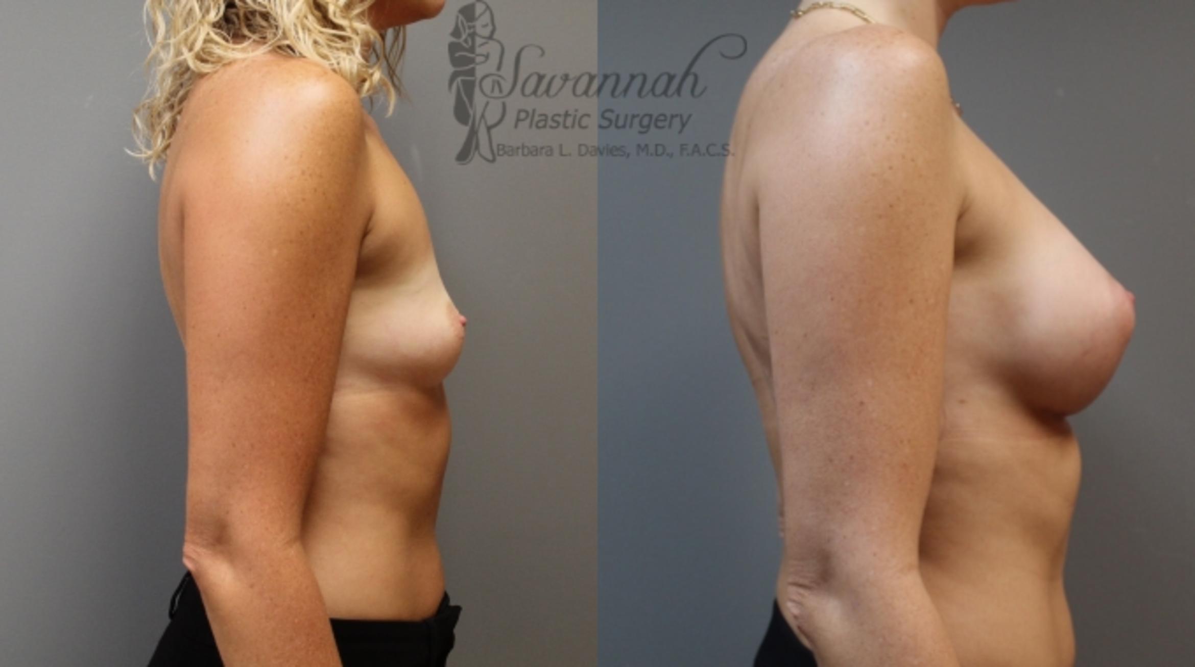 Before & After Breast Augmentation Case 7 View 3 View in Savannah, Georgia