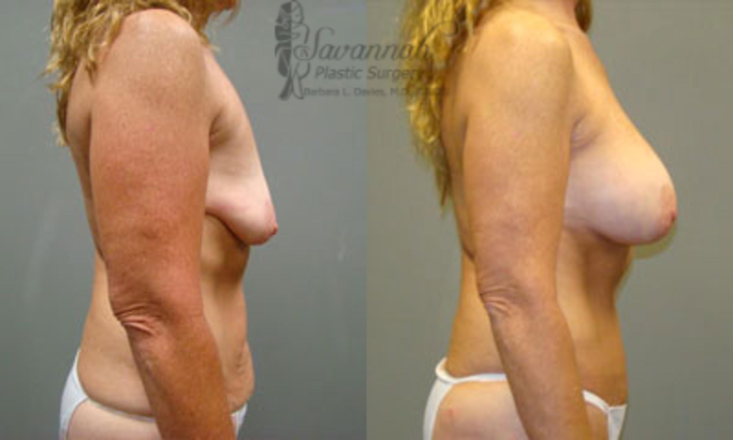 Before & After Breast Augmentation Case 8 View 2 View in Savannah, Georgia
