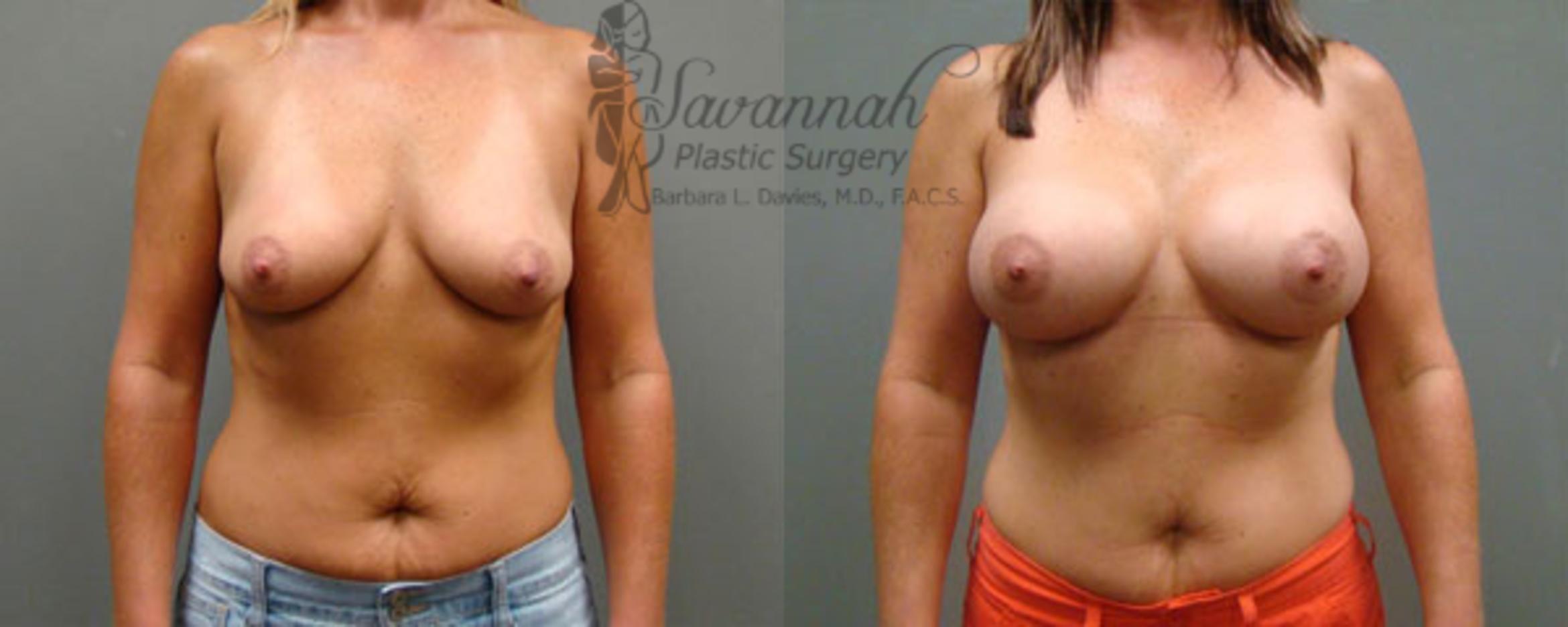 Before & After Breast Augmentation Case 9 View 1 View in Savannah, Georgia