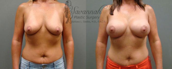 Before & After Breast Augmentation Case 9 View 1 View in Savannah, Georgia