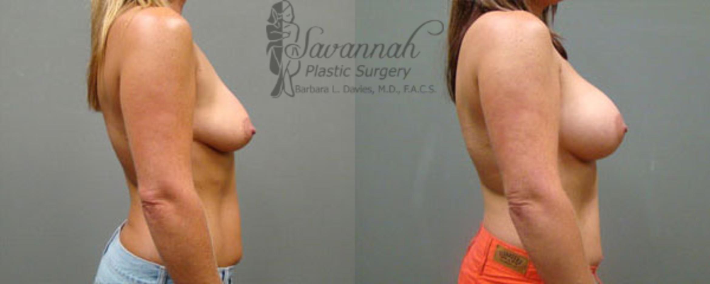 Before & After Breast Augmentation Case 9 View 2 View in Savannah, Georgia