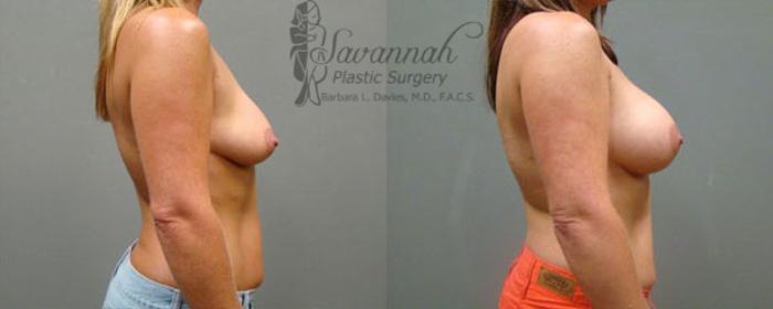 Before & After Breast Augmentation Case 9 View 2 View in Savannah, Georgia