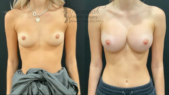 Before & After Breast Augmentation Case 93 Front View in Savannah, Georgia