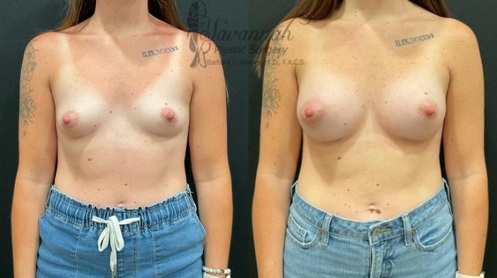 Before & After Breast Augmentation Case 94 Front View in Savannah, Georgia