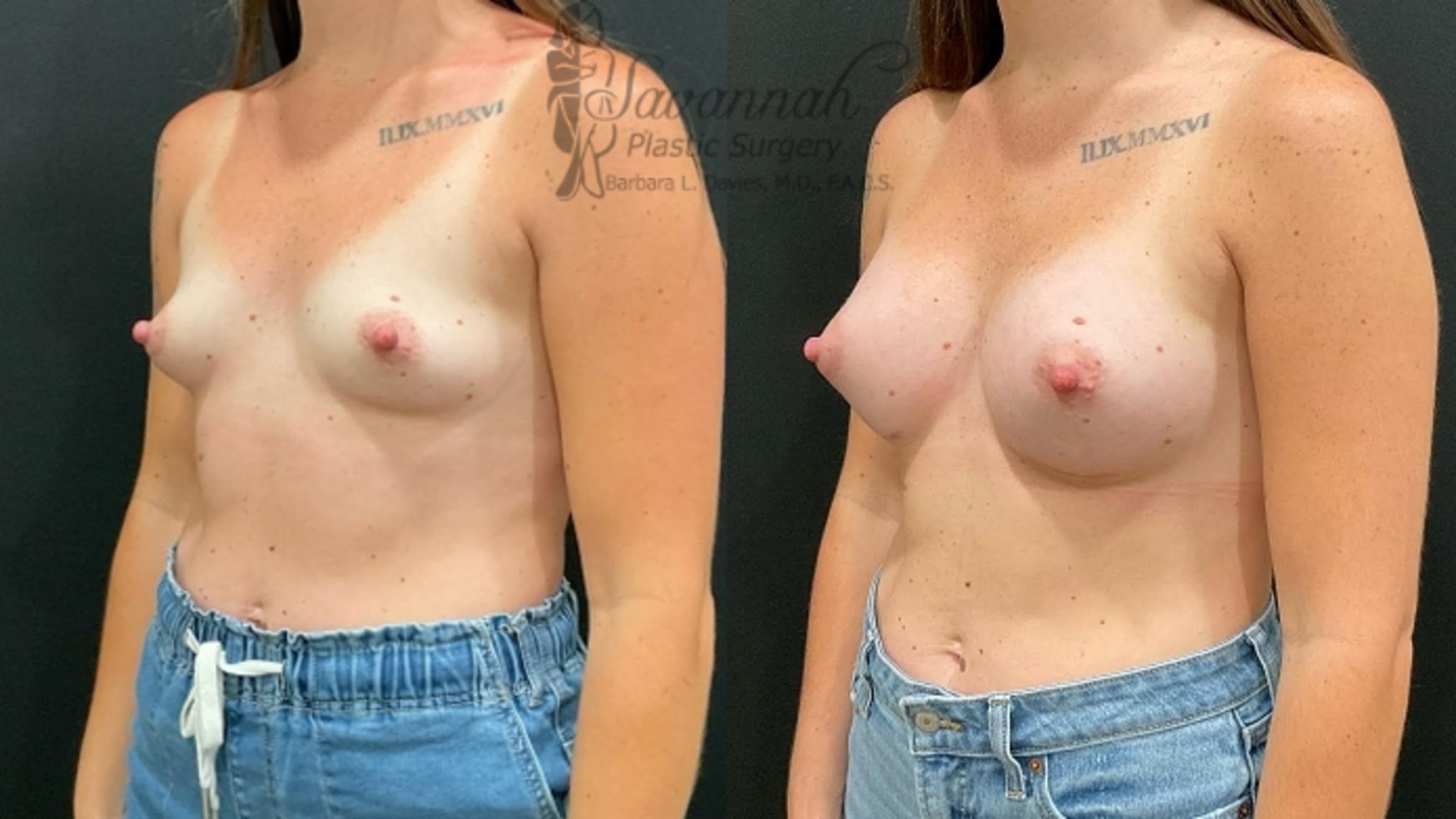 Before & After Breast Augmentation Case 94 Left Oblique View in Savannah, Georgia