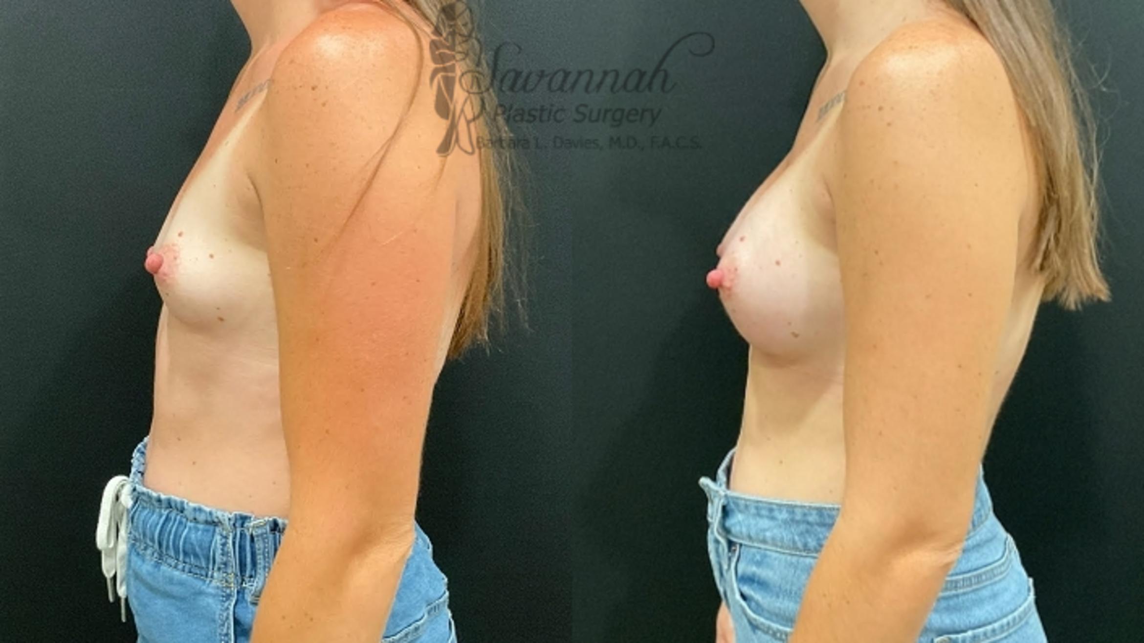 Before & After Breast Augmentation Case 94 Left Side View in Savannah, Georgia