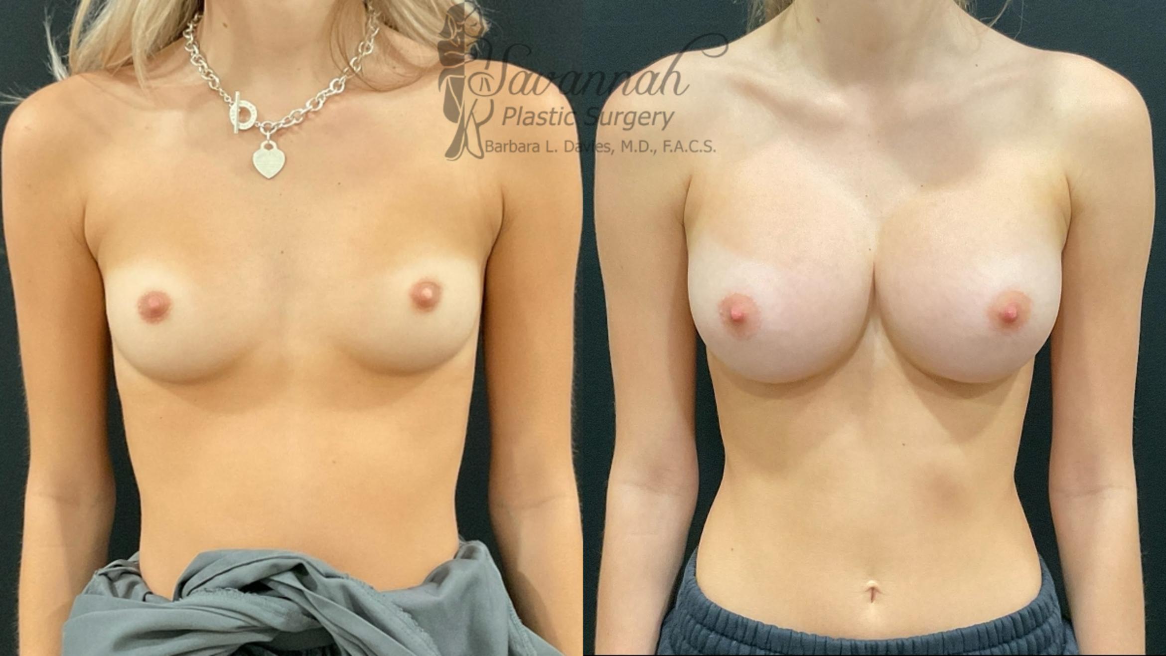 Before & After Breast Augmentation Case 97 Front View in Savannah, Georgia