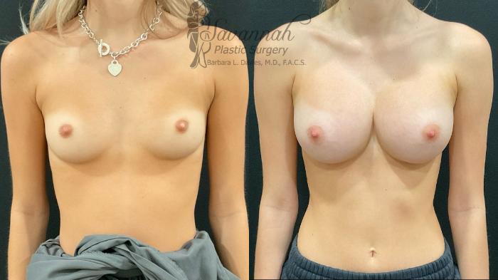 Before & After Breast Augmentation Case 97 Front View in Savannah, Georgia