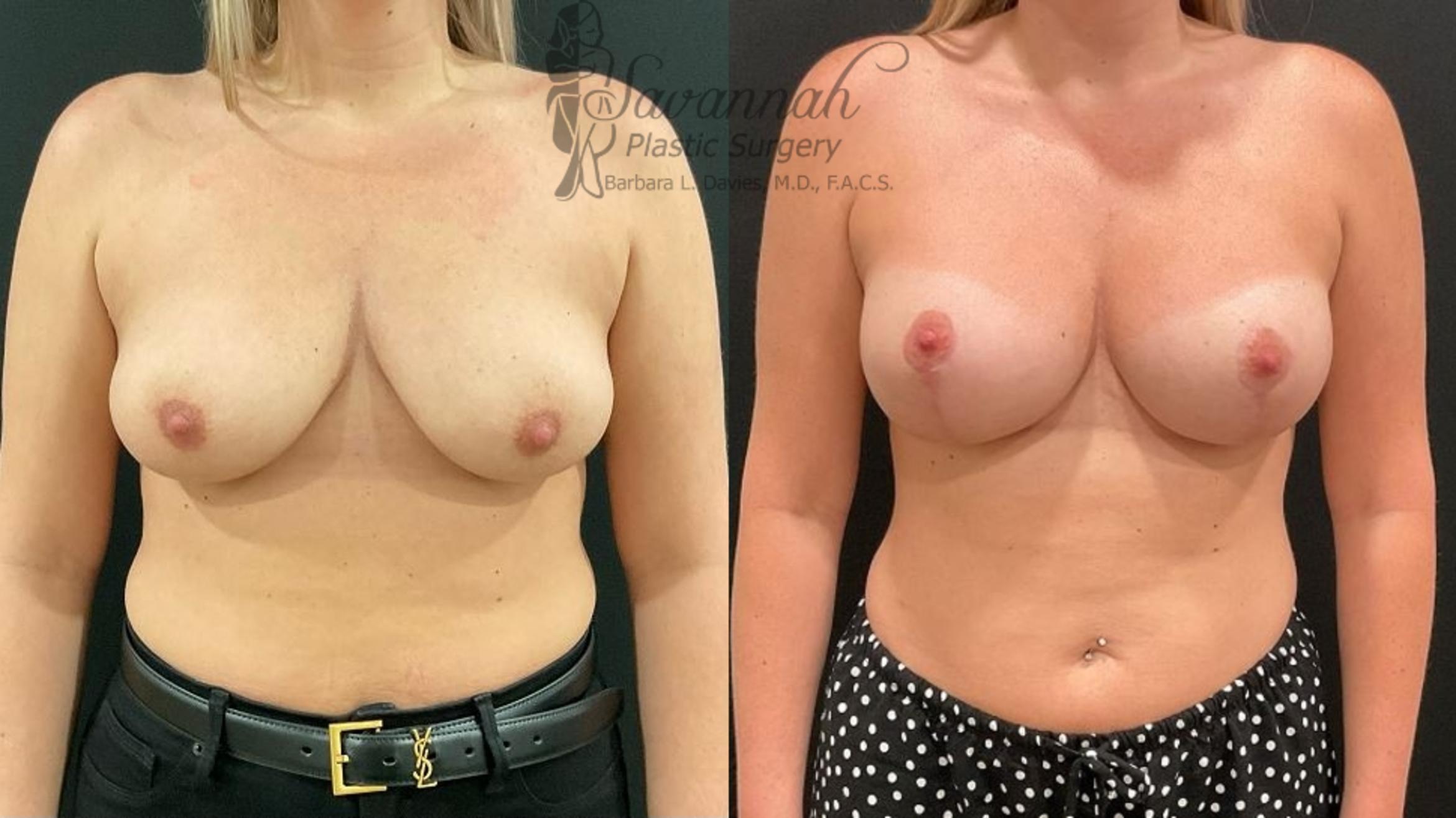 Before & After Breast Lift Case 100 Front View in Savannah, Georgia