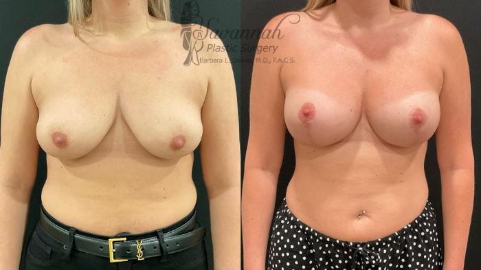 Before & After Breast Lift Case 100 Front View in Savannah, Georgia