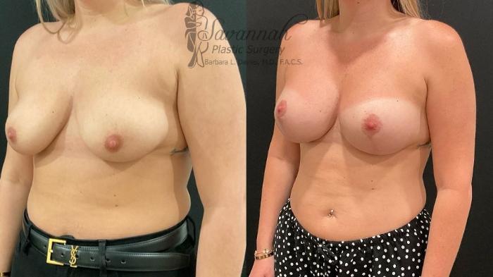 Before & After Breast Lift Case 100 Left Oblique View in Savannah, Georgia