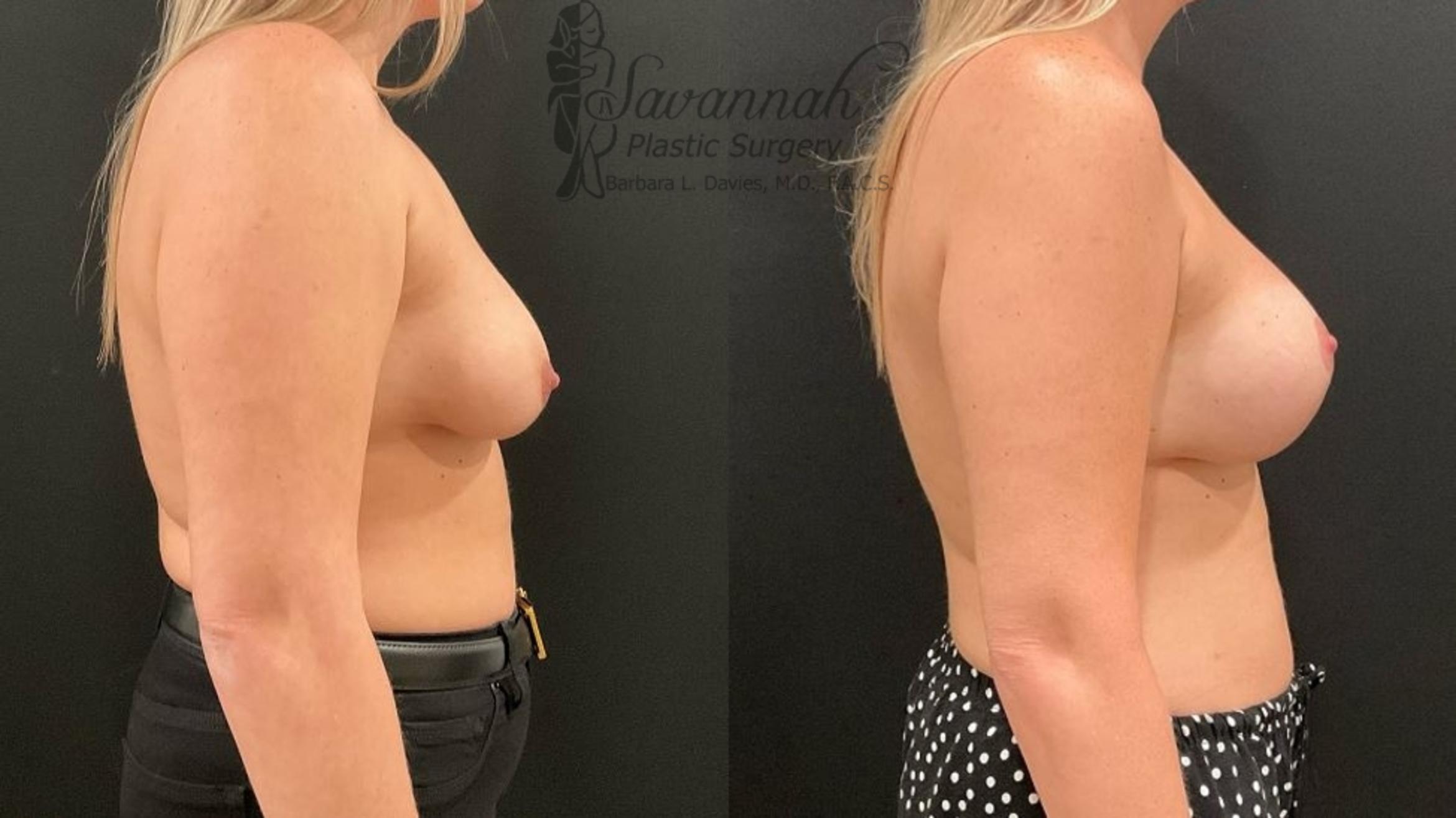 Before & After Breast Lift Case 100 Right Side View in Savannah, Georgia