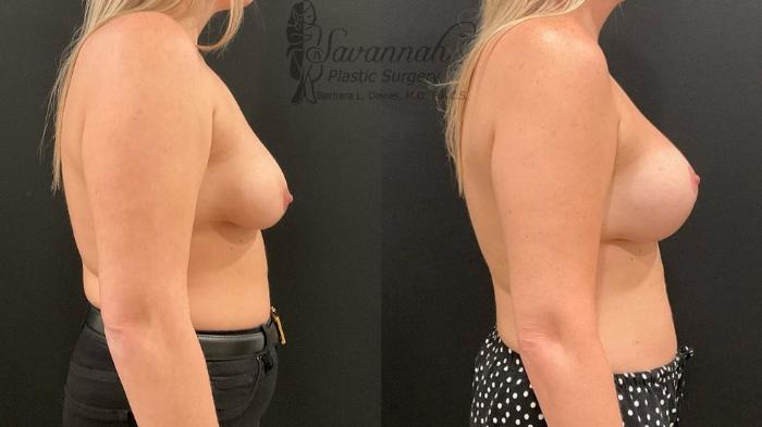 Before & After Breast Lift Case 100 Right Side View in Savannah, Georgia