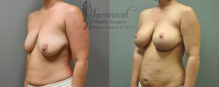 Before & After Breast Lift Case 18 View 2 View in Savannah, Georgia
