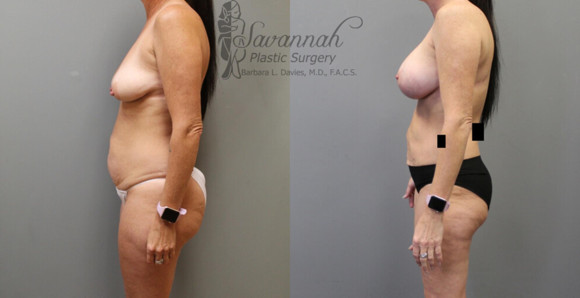 Before & After Liposuction Case 19 View 2 View in Savannah, Georgia