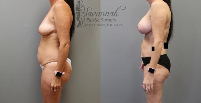 Before & After Liposuction Case 19 View 2 View in Savannah, Georgia