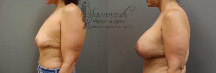 Before & After Breast Lift Case 20 View 2 View in Savannah, Georgia