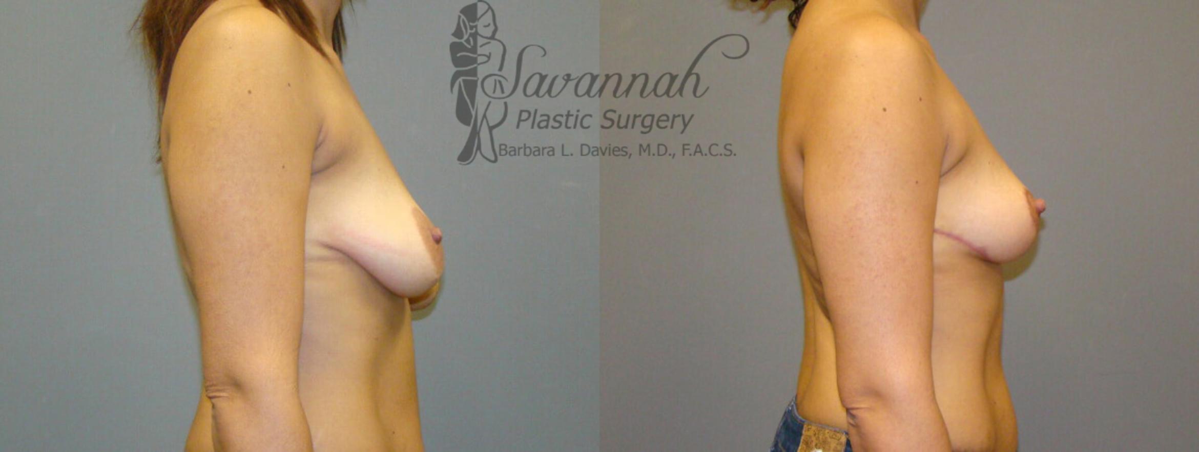 Before & After Breast Lift Case 21 View 2 View in Savannah, Georgia