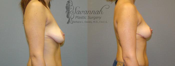 Before & After Breast Lift Case 21 View 2 View in Savannah, Georgia