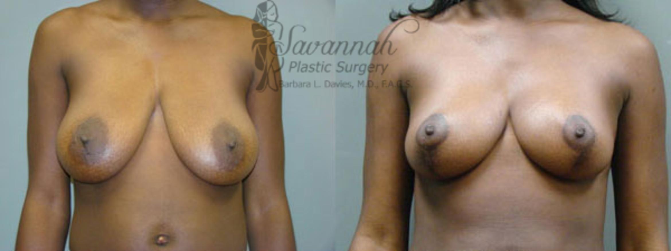 Before & After Breast Reduction Case 23 View 1 View in Savannah, Georgia