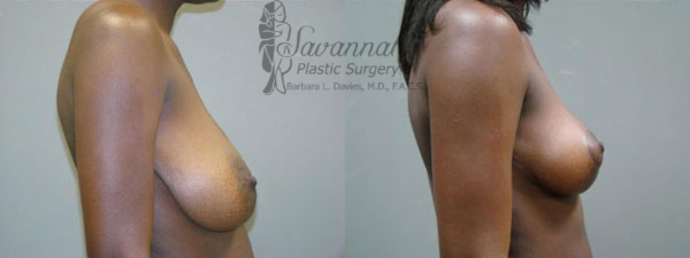 Before & After Breast Reduction Case 23 View 2 View in Savannah, Georgia
