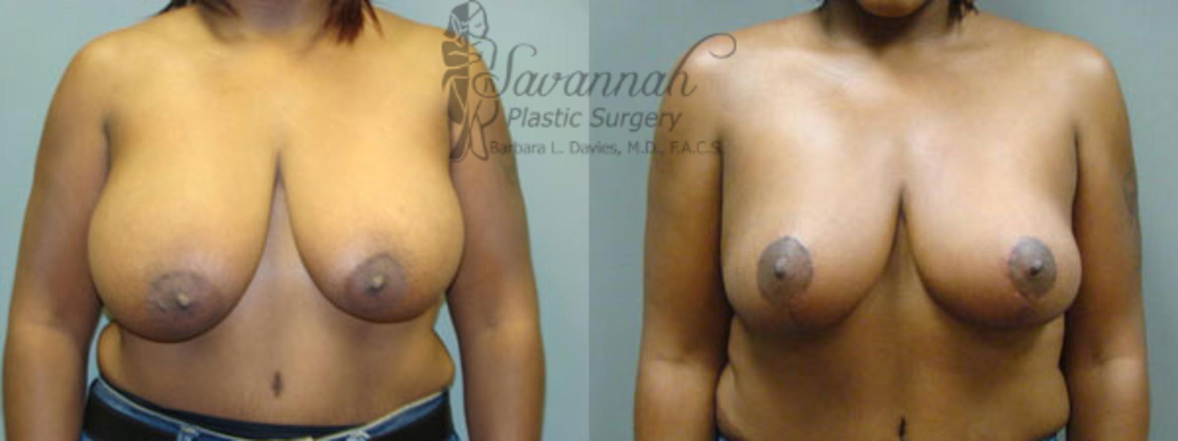 Before & After Breast Reduction Case 24 View 1 View in Savannah, Georgia