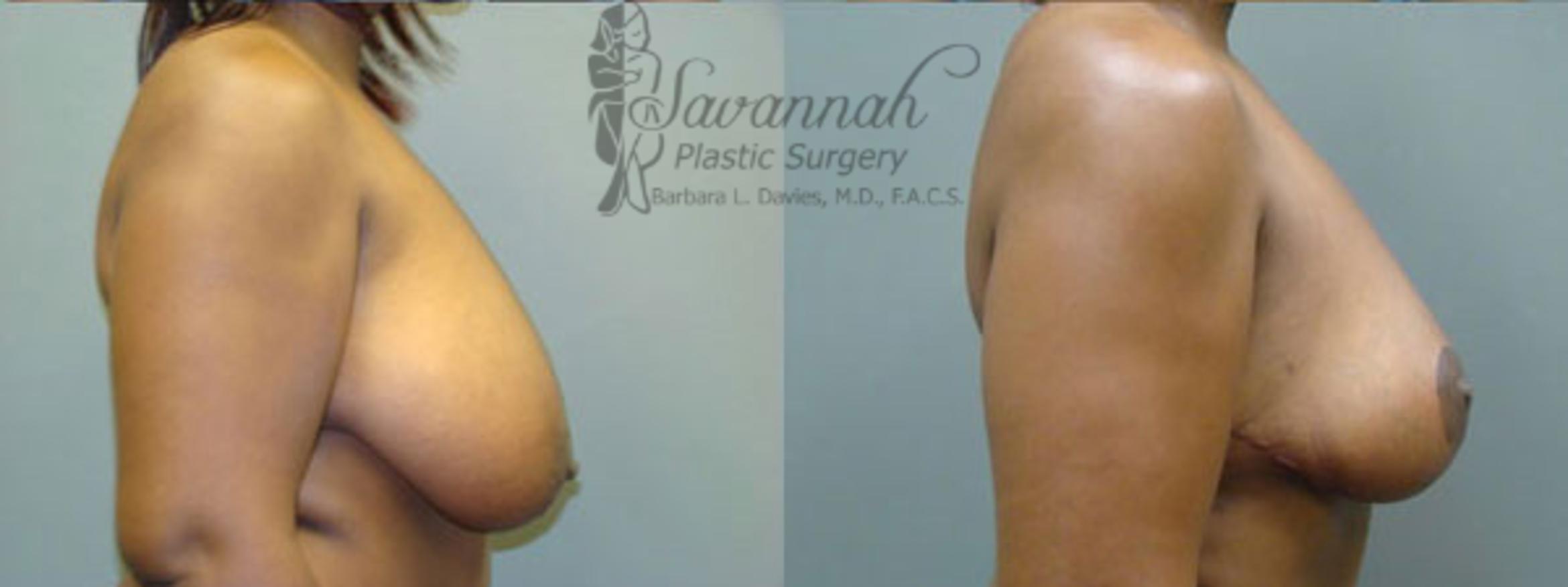 Before & After Breast Reduction Case 24 View 2 View in Savannah, Georgia