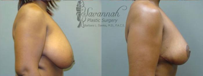 Before & After Breast Reduction Case 24 View 2 View in Savannah, Georgia