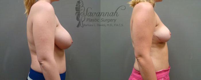 Before & After Breast Reduction Case 25 View 2 View in Savannah, Georgia