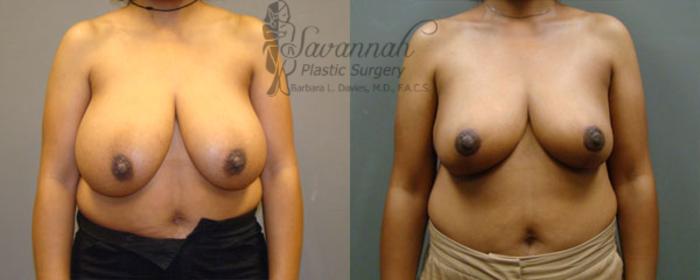 Before & After Breast Reduction Case 26 View 1 View in Savannah, Georgia
