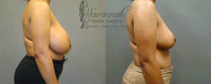 Before & After Breast Reduction Case 26 View 2 View in Savannah, Georgia