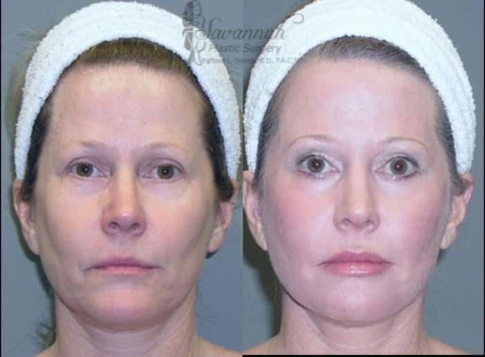 Before & After Dermal Fillers & Injectables Case 82 View 1 View in Savannah, Georgia