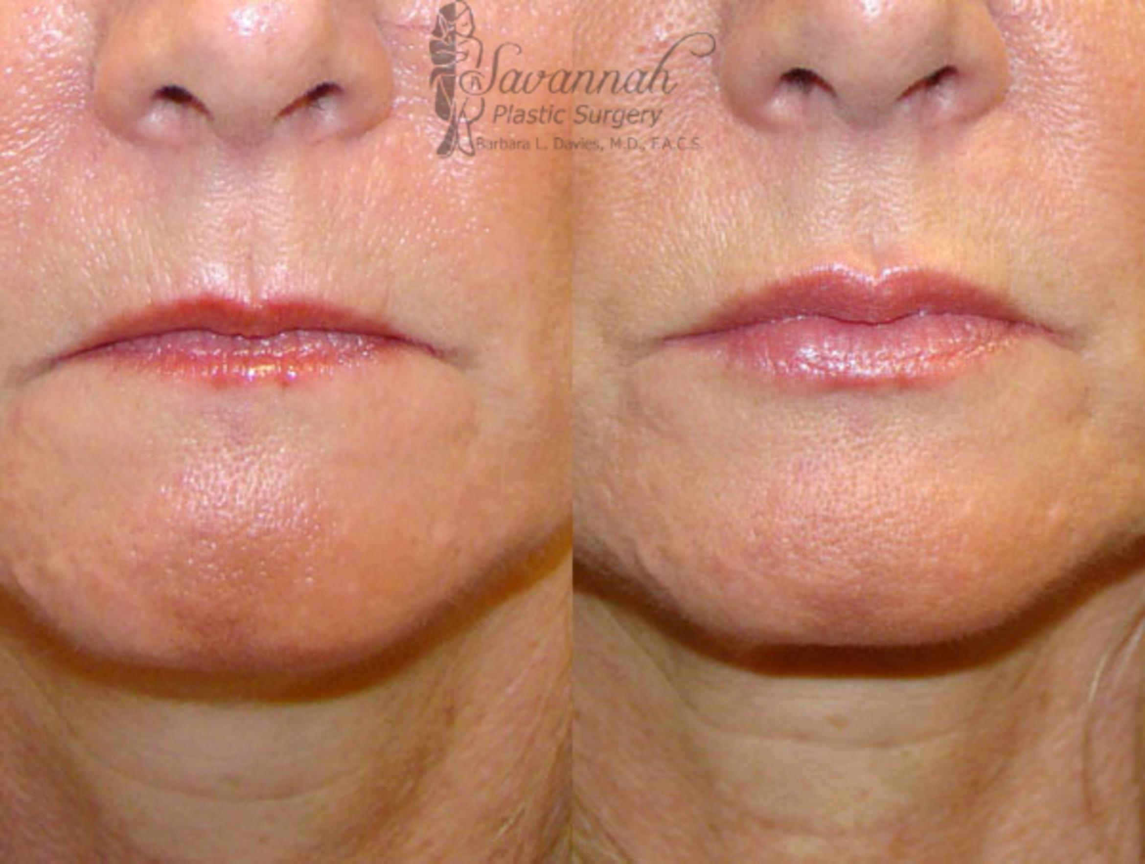 Before & After Dermal Fillers & Injectables Case 83 View 1 View in Savannah, Georgia