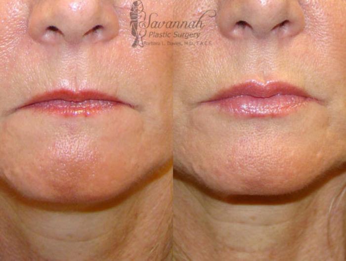 Before & After Dermal Fillers & Injectables Case 83 View 1 View in Savannah, Georgia