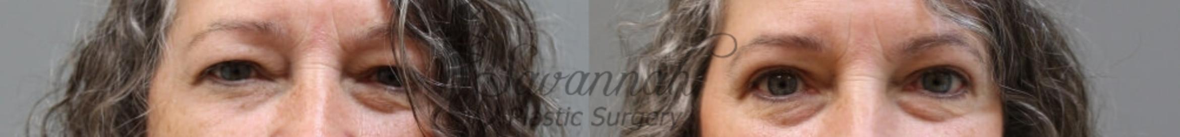 Before & After Eyelid Surgery Case 61 View 1 View in Savannah, Georgia