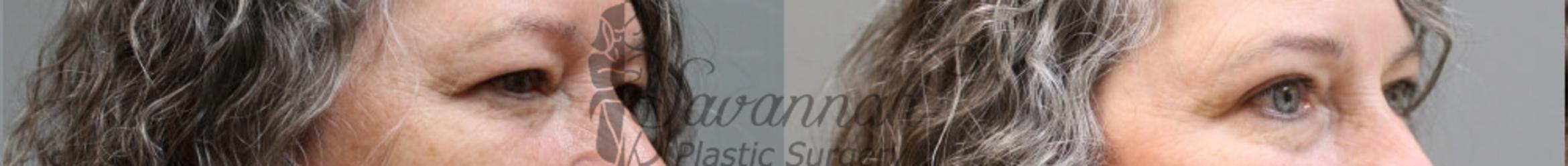 Before & After Eyelid Surgery Case 61 View 2 View in Savannah, Georgia
