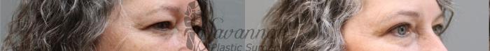 Before & After Eyelid Surgery Case 61 View 2 View in Savannah, Georgia