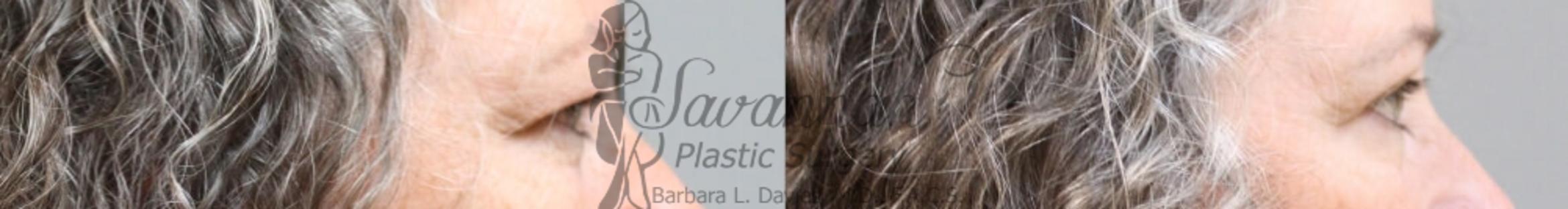 Before & After Eyelid Surgery Case 61 View 3 View in Savannah, Georgia