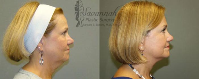 Before & After Eyelid Surgery Case 63 View 2 View in Savannah, Georgia