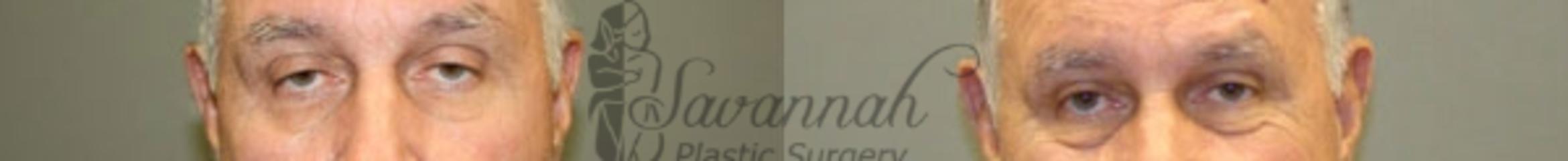 Before & After Eyelid Surgery Case 64 View 1 View in Savannah, Georgia