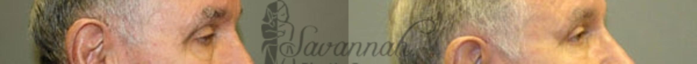 Before & After Eyelid Surgery Case 64 View 2 View in Savannah, Georgia