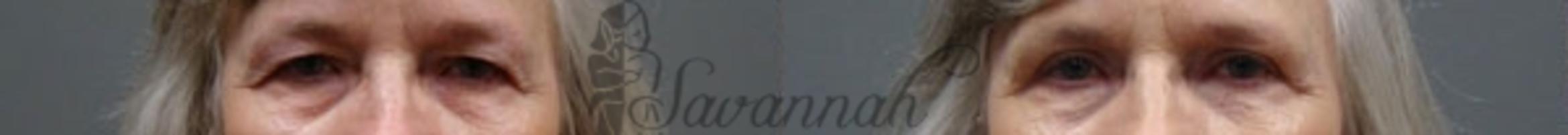 Before & After Eyelid Surgery Case 65 View 1 View in Savannah, Georgia