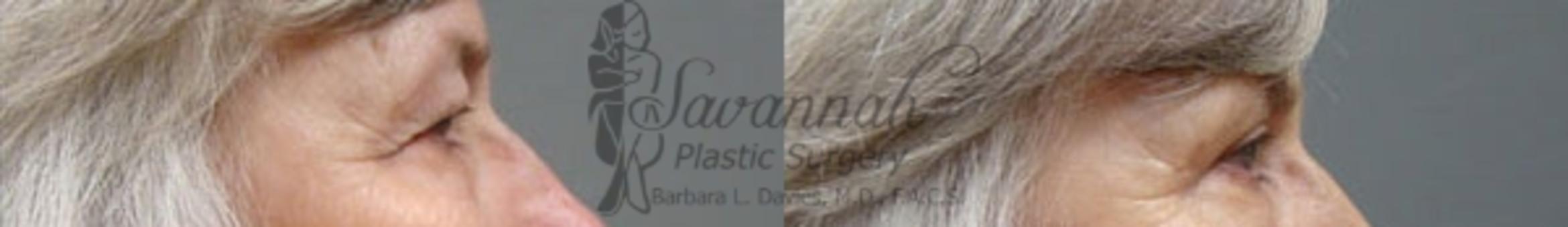 Before & After Eyelid Surgery Case 65 View 2 View in Savannah, Georgia