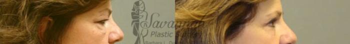 Before & After Eyelid Surgery Case 66 View 2 View in Savannah, Georgia