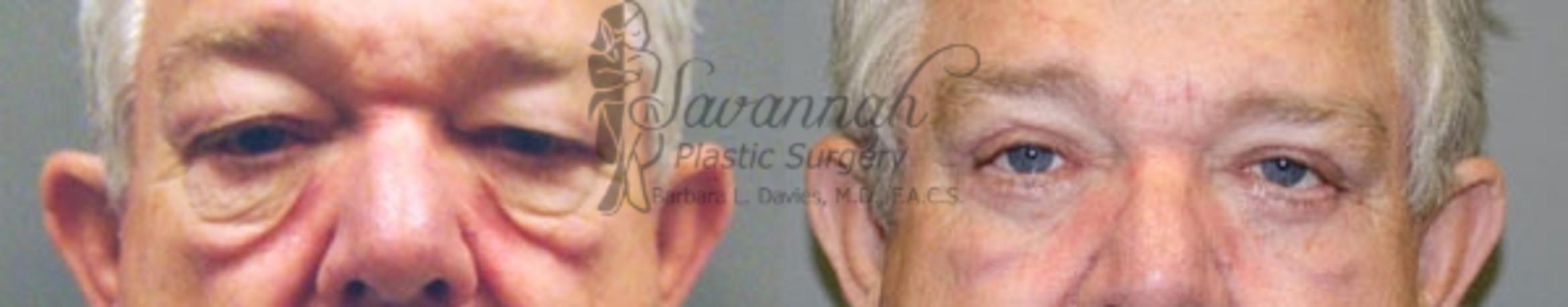 Before & After Eyelid Surgery Case 67 View 1 View in Savannah, Georgia
