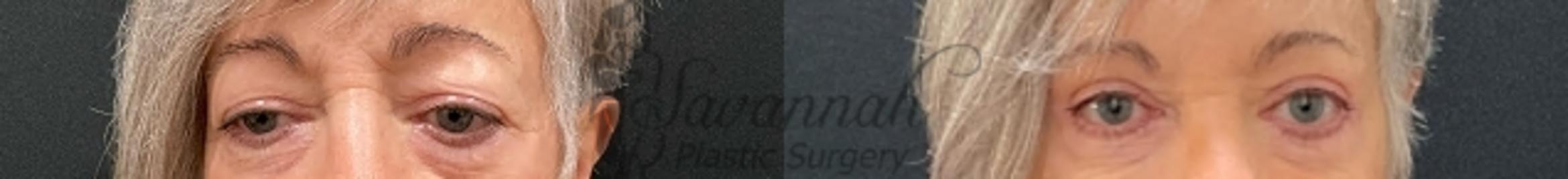 Before & After Eyelid Surgery Case 90 Front View in Savannah, Georgia